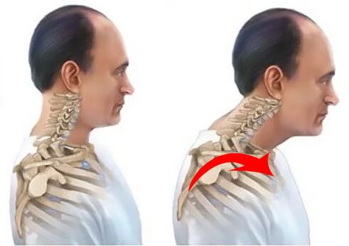 Spine saine et malade